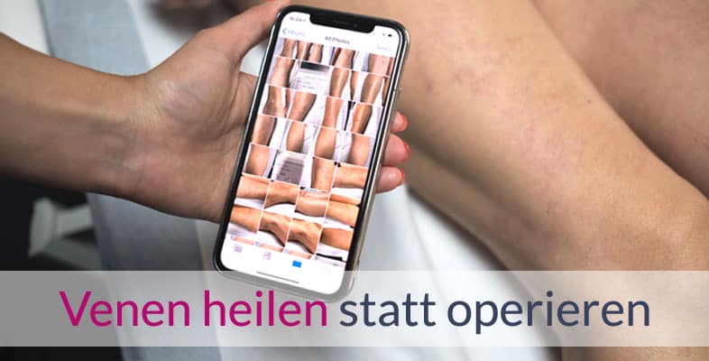 Venen heilen statt operieren